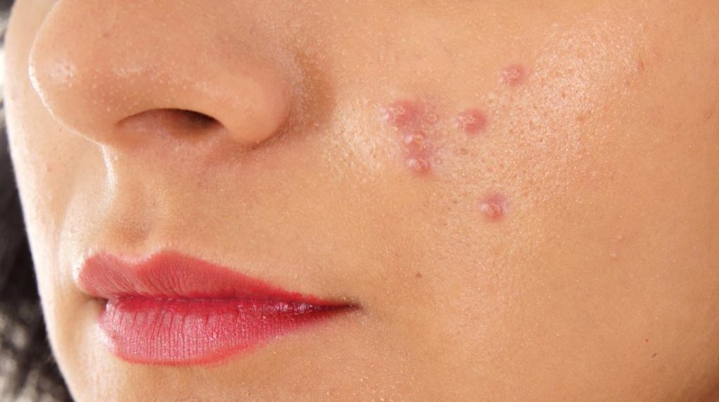 पिम्पल्स हटाने के तरीके घरेलू उपाय और नुस्खे Pimples Kil Muhase ke Gharelu Upay in Hindi﻿