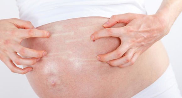 गर्भावस्था में पेट की खुजली से बचने के घरेलू उपाय एवं तरीके Home Remedies Treatment for Pregnancy treatments in hindi